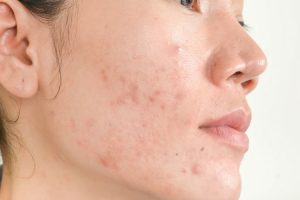 Khasiat Collagen untuk Kulit Wajah yang Berjerawat
